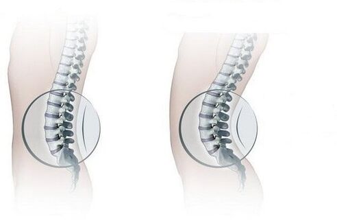 Normal spine and increased lumbar lordosis