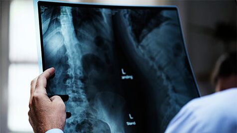 X-rays of the spine with osteochondrosis